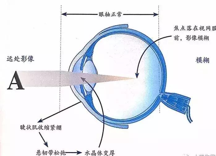 儿童近视有效的三个方法,儿童近视的四大误区