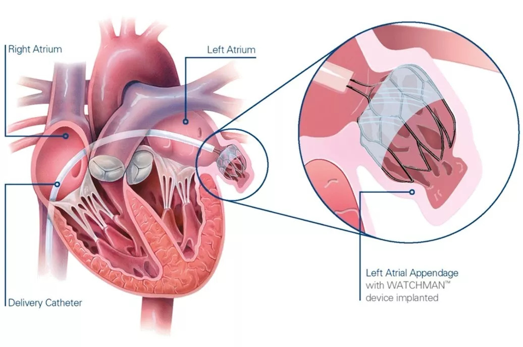 治房颤新技术叫什么,治房颤的应急中成药