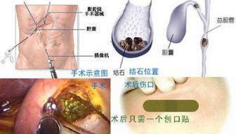保胆取泥沙型胆结石,保胆取结石术