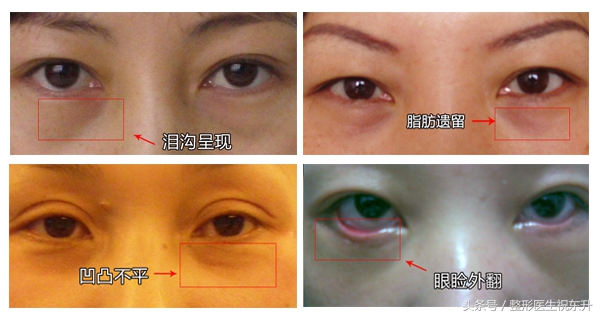 真相来了｜做去眼袋手术失败了，该怎么办？