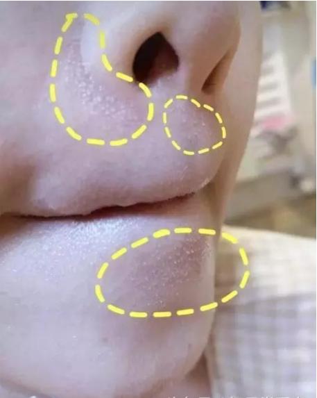 抿嘴出现的白色小颗粒,嘴下面起的密密麻麻大疙瘩是什么