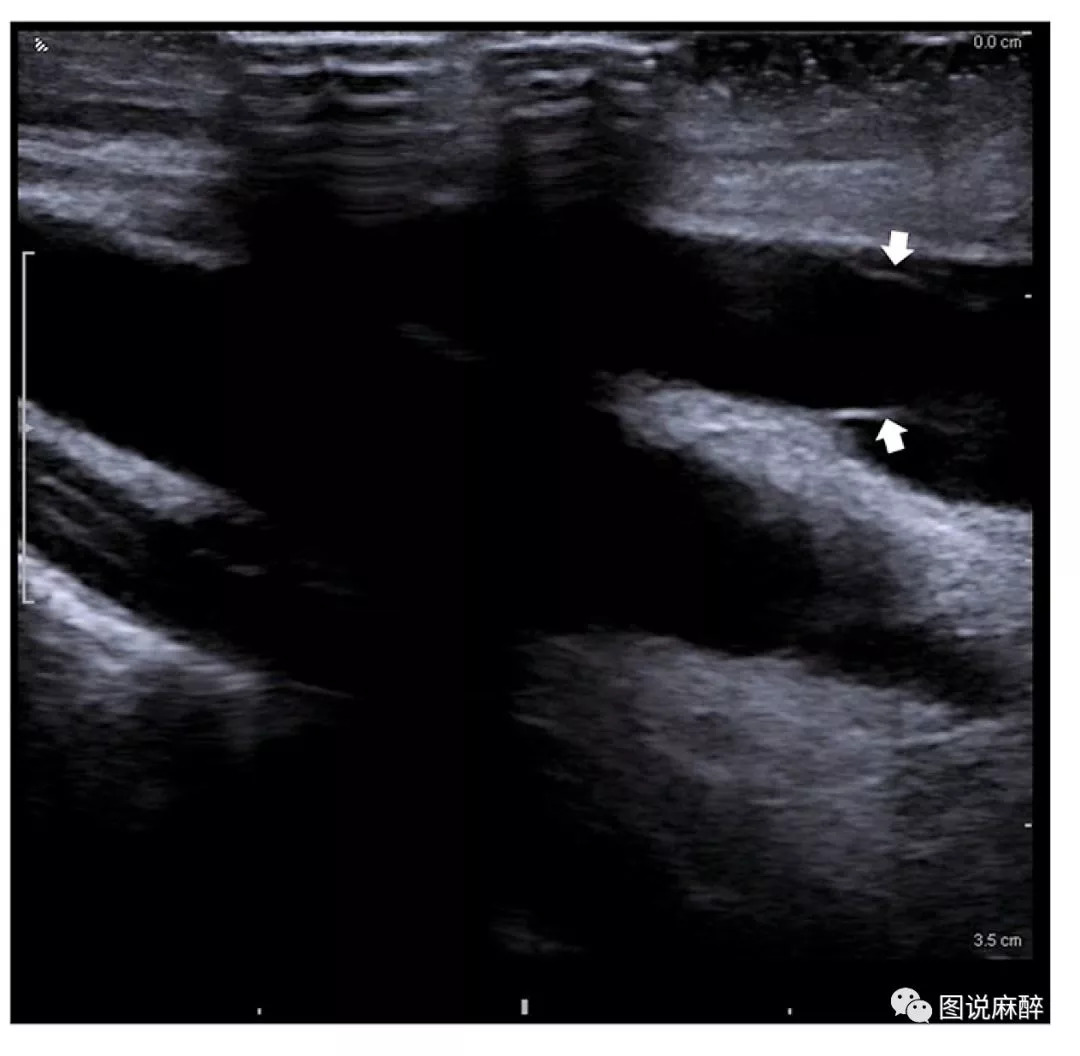 深静脉穿刺置管术拔出后疼痛,深静脉穿刺置管深度一般多少厘米