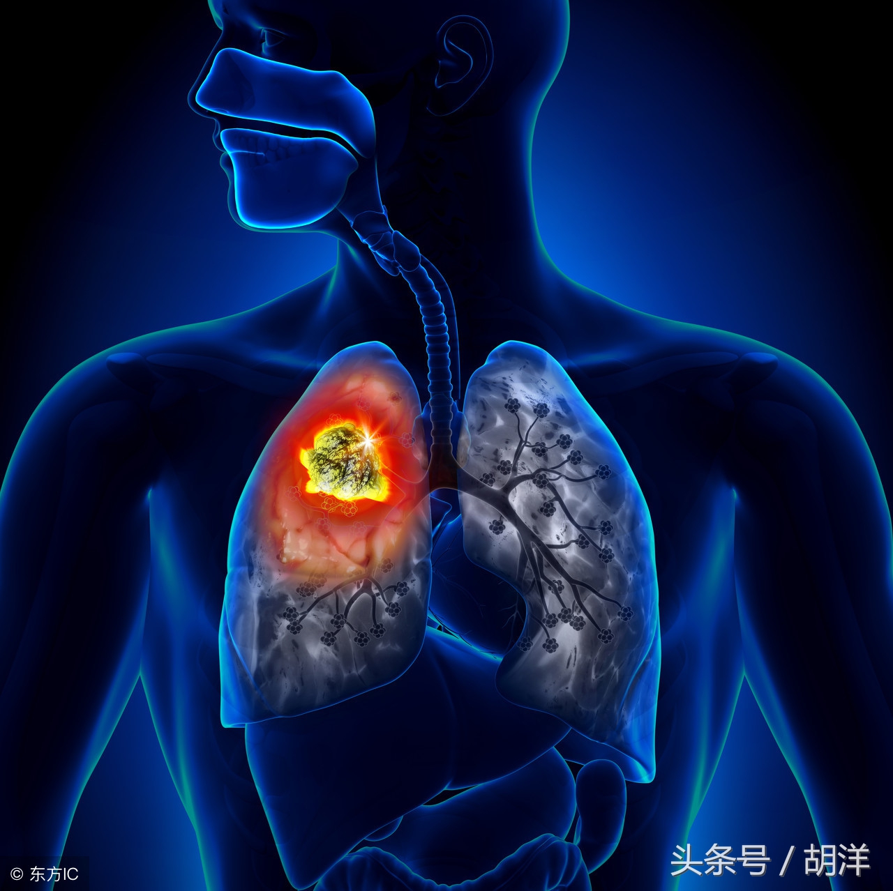 肺癌肝转移患者后期会怎样,肺癌肝转移怎么处理