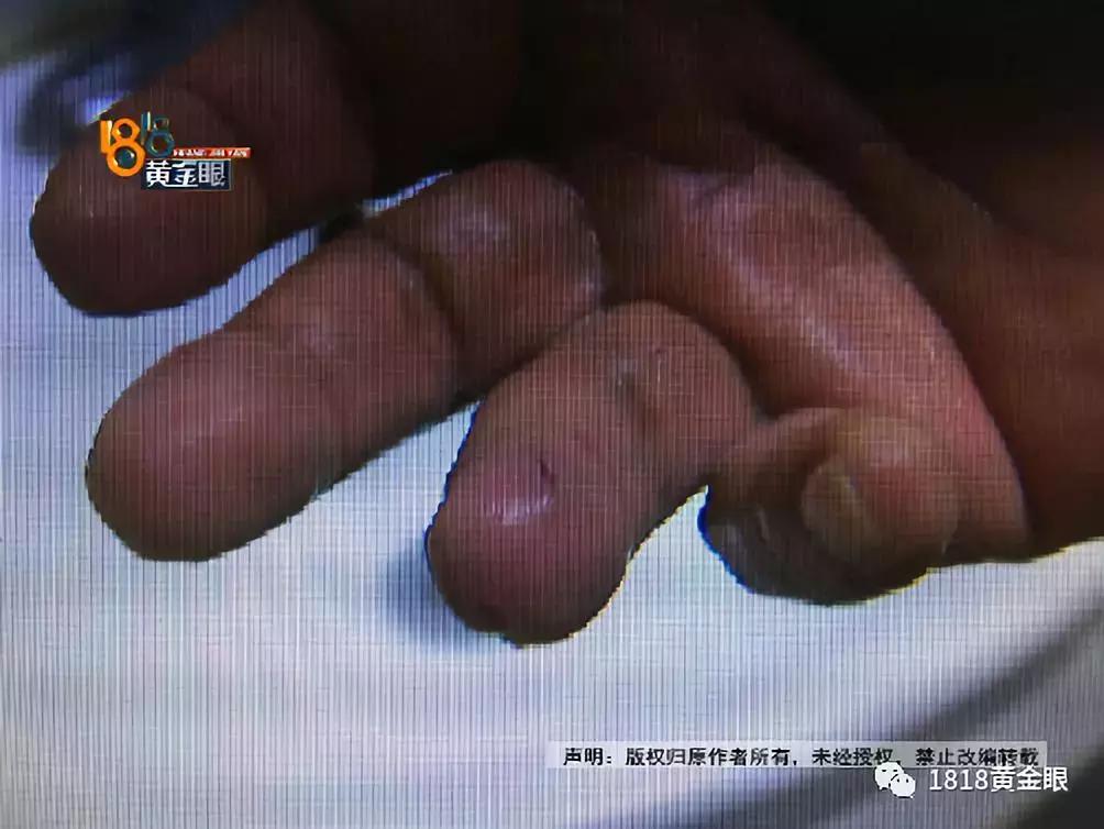 湖州6岁男童被狗咬伤,十几天后没了,确诊为狂犬病,听医生讲讲被狗咬伤后怎么处理