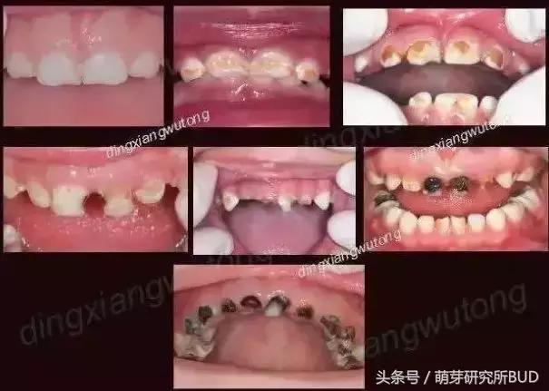 儿童牙齿龋齿怎么处理和保养,乳牙龋齿怎么办有好方法吗
