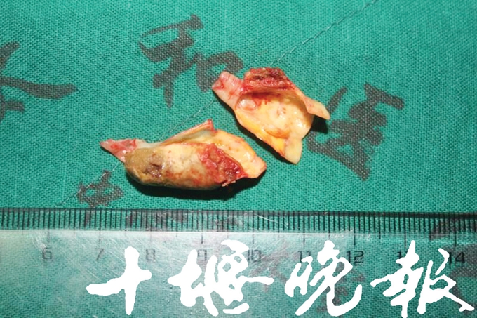 颈动脉血管狭窄头晕脑胀吃什么药,颈动脉天生血管细头晕怎么治疗