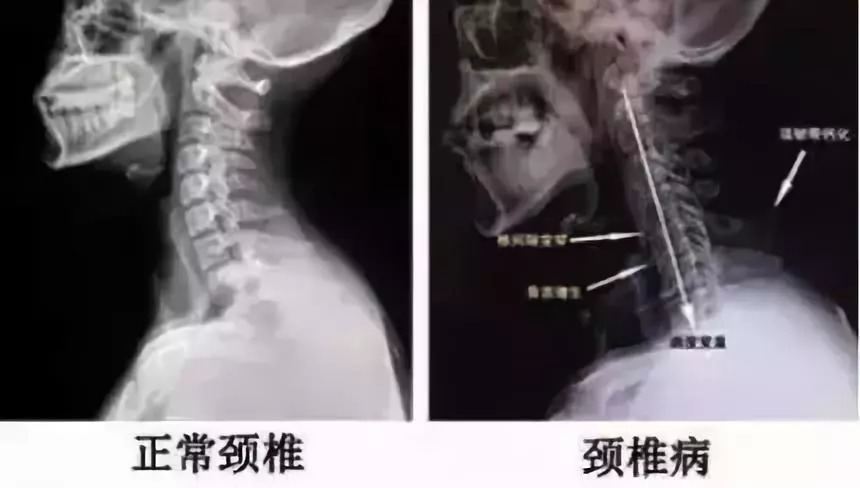 一个动作拯救你的颈椎,3个动作拯救你的颈椎