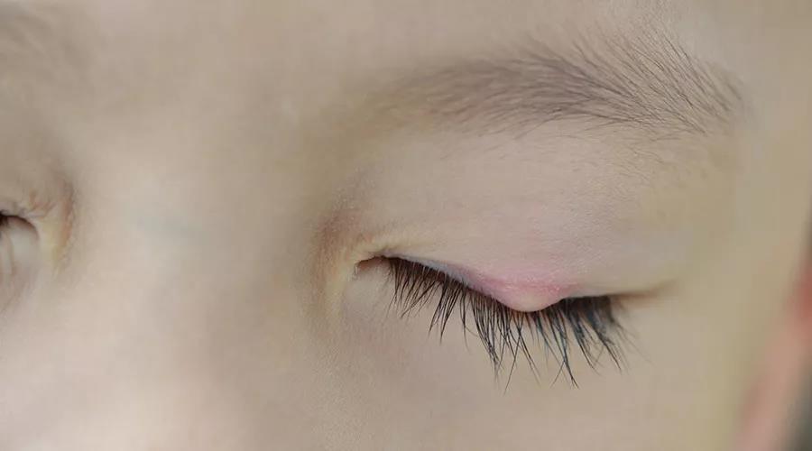 眼睛里面长了白色的小痘痘怎么治,眼睛长了像痘痘一样的东西怎么办