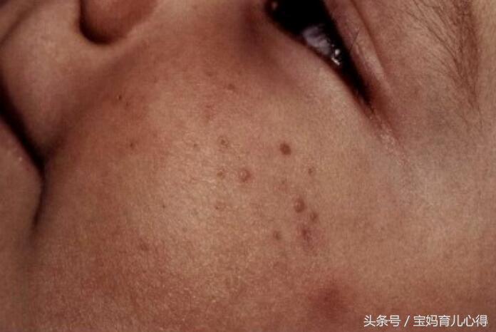 宝宝常见皮肤病家长们看过来,宝妈必须知道的五种皮疹