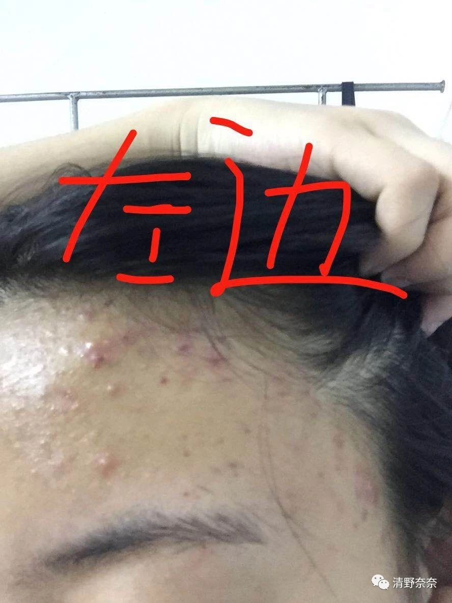 海绵微针后怎么护理,海绵微针第二天怎么护理