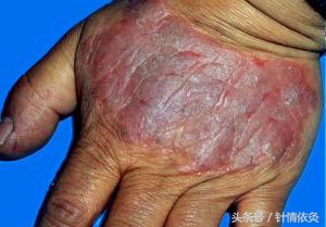 针灸治疗湿疹最佳时间,针灸能治慢性湿疹吗