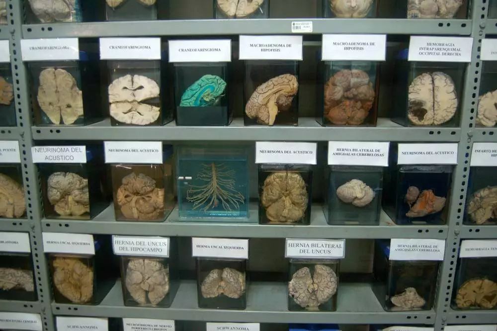 中国脑囊虫病,巨大脑囊虫病