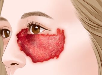 血管瘤的症状是什么怎么治疗,血管瘤的症状与治疗方法