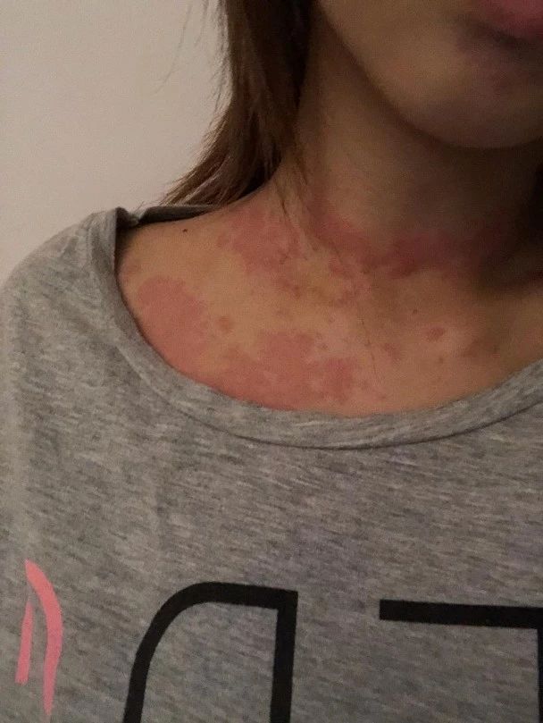 颈部以下红疹,全身长满红色的小疹子而且特别痒
