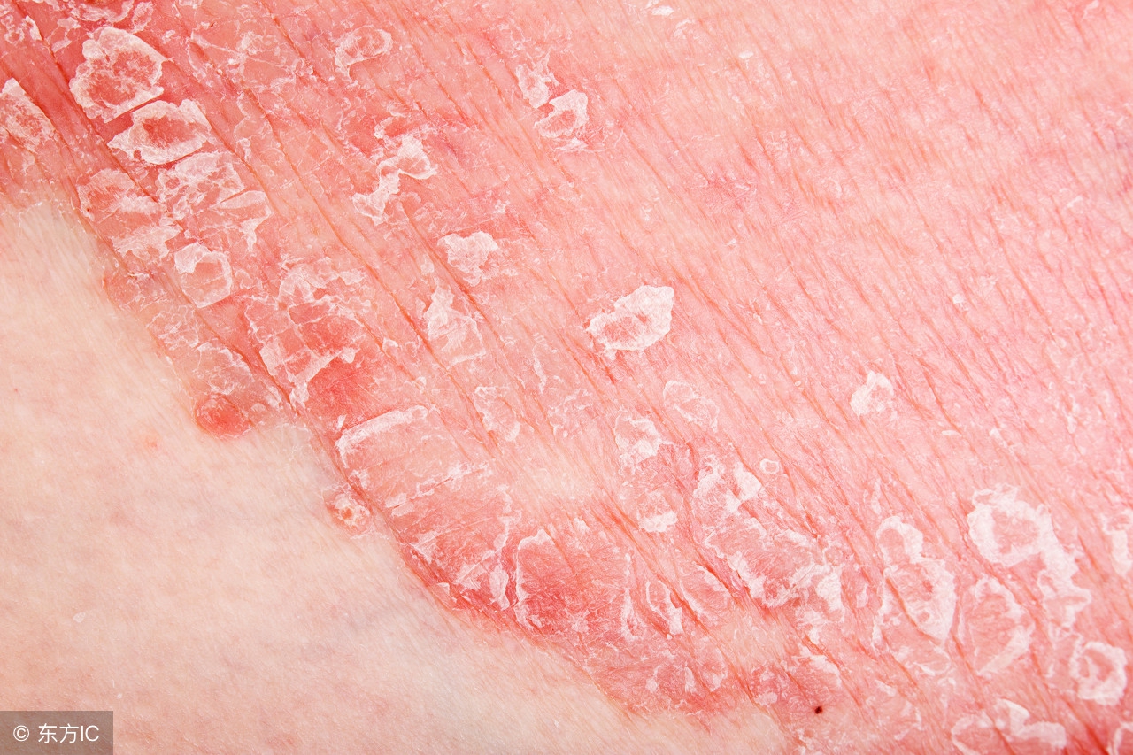 疱疹是空气传染还是飞沫传染,生殖器疱疹怎么预防传染