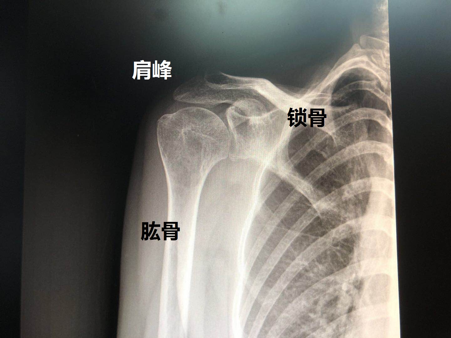 肩周炎手术松解后的锻炼方法图解,肩周炎手术治疗后怎么锻炼