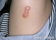 针灸可以治疗疤痕增生吗,中医针灸可以去除瘢痕