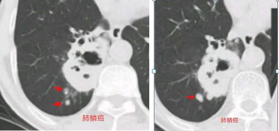 晚期肺癌6年后肿瘤缩小两倍,他的秘诀:放化疗+地图+敬老院+偏方