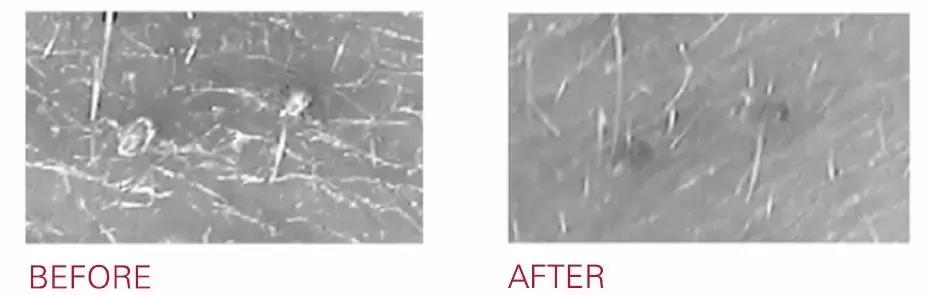 战痘的四个小方法,战痘女孩的秘笈