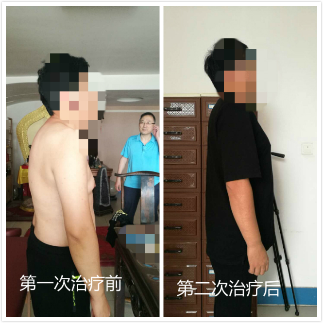 弯驼腰最好的治疗方法,弓腰驼背成人怎么矫正