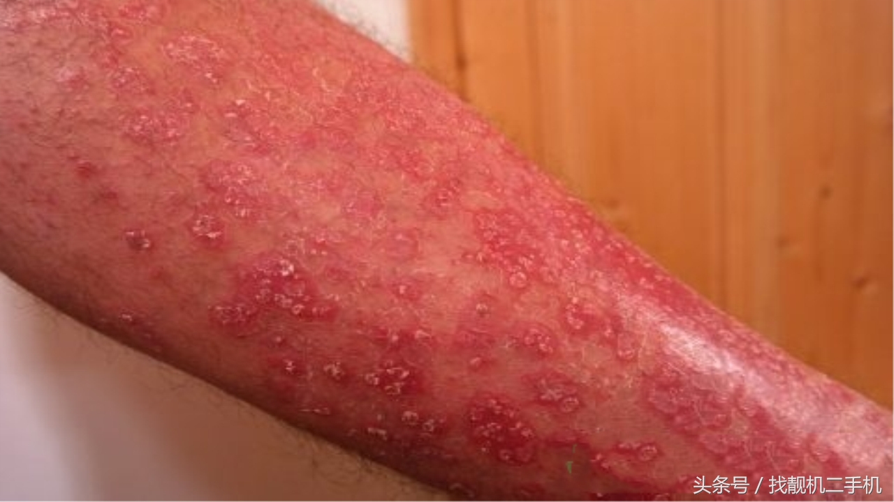 古代天花难治吗,古代天花大爆发