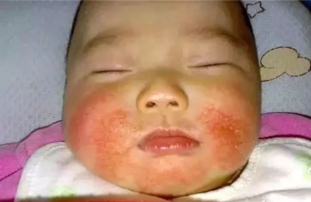 秋季宝宝身上长痒疙瘩,秋季孩子身上痒是什么原因