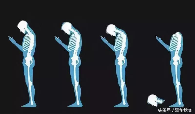 吓尿！每天玩手机4小时，8年后开刀换骨！颈椎病，正疯狂袭来！