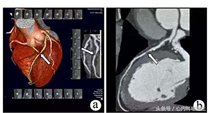 长期药物治疗可以减轻冠状动脉狭窄、减少心绞痛和心梗发生