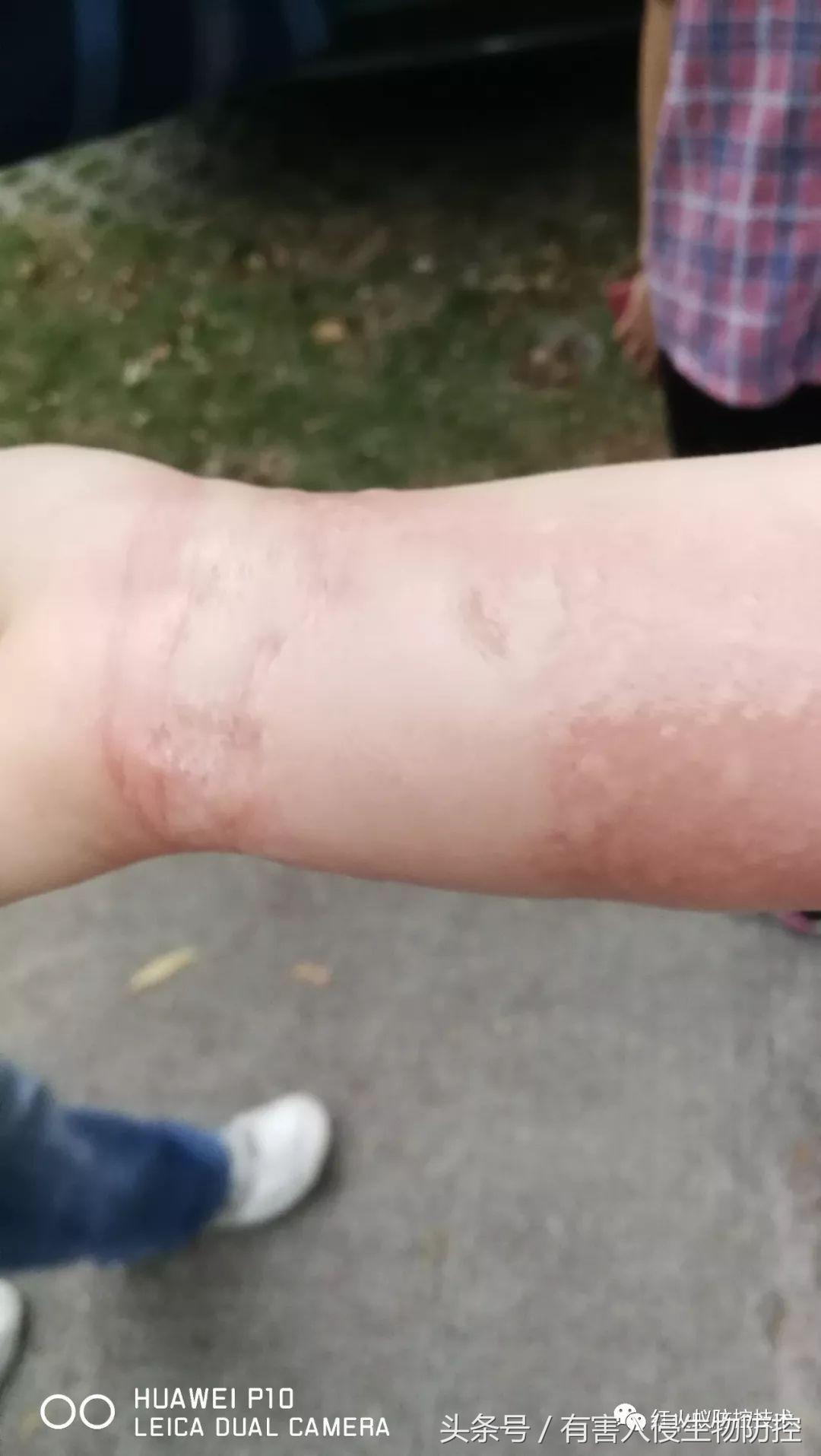 被红火蚁咬的治疗方法,被红火蚁咬后怎么处理偏方