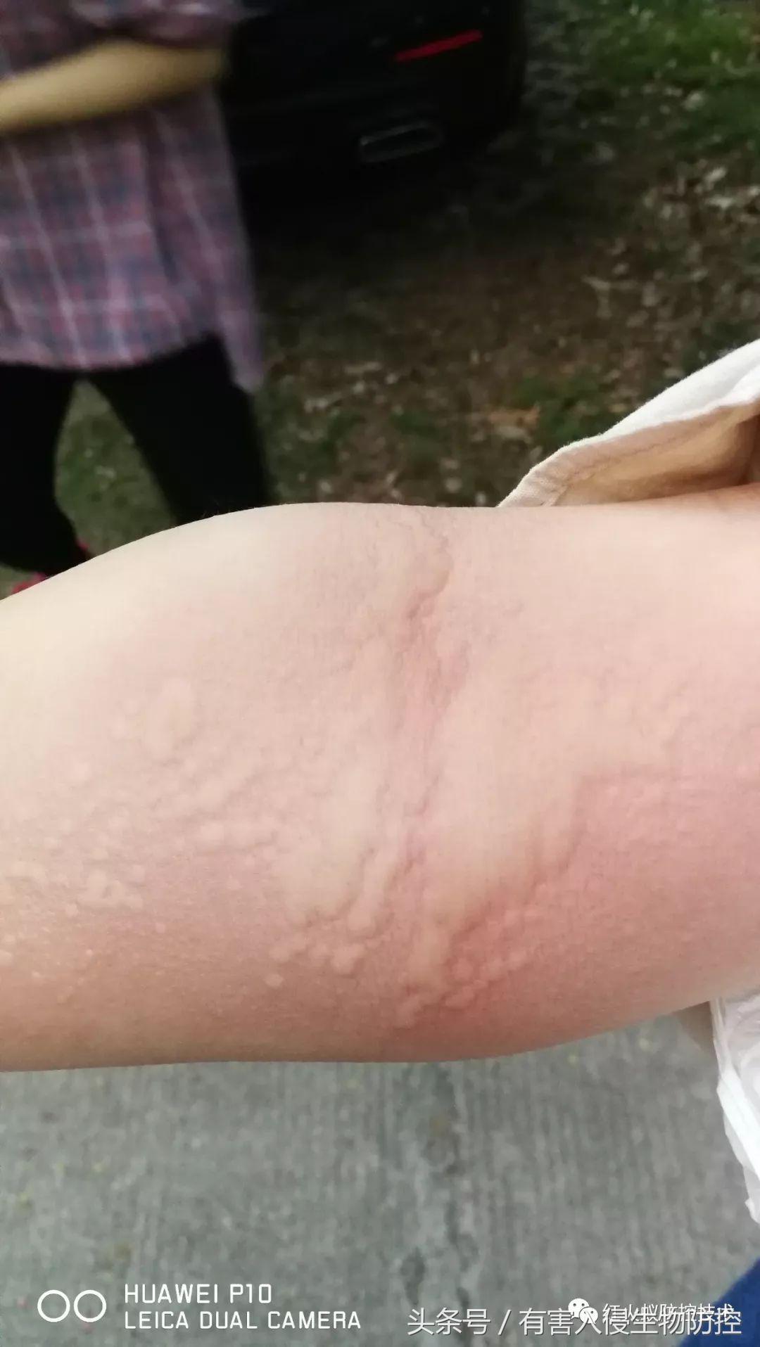 被红火蚁咬的治疗方法,被红火蚁咬后怎么处理偏方