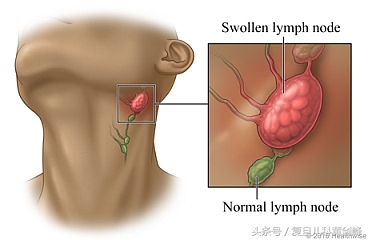 脖子上喉咙部位摸到一个小疙瘩,脖子上摸到会动的疙瘩怎么回事