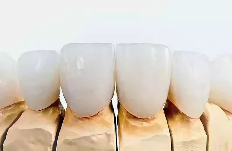 烤瓷牙与全瓷牙价格对比,烤瓷牙和全瓷牙价格差多少钱一颗