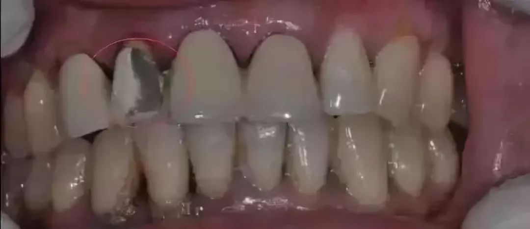 烤瓷牙与全瓷牙价格相差近十倍?究竟贵在哪?