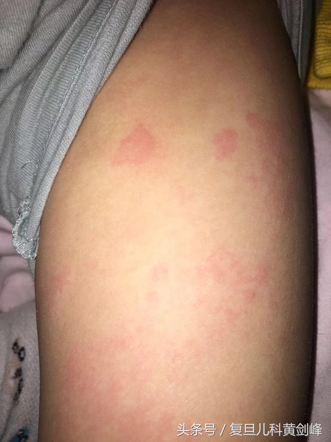 宝宝风疹块怎么引起的,宝宝身上起风疹块原因