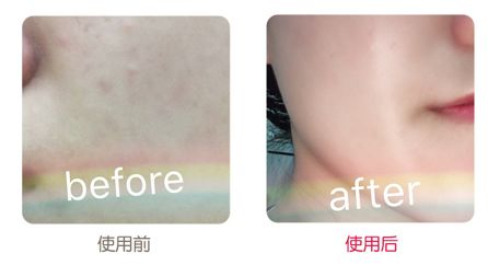 有了这瓶“液体黄金“,今年秋冬注定与干燥、长痘无缘了!