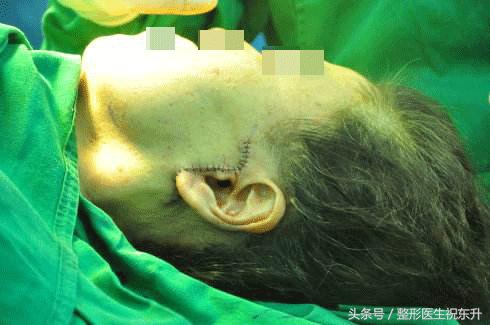45岁做拉皮手术,44岁女人拉皮手术48天
