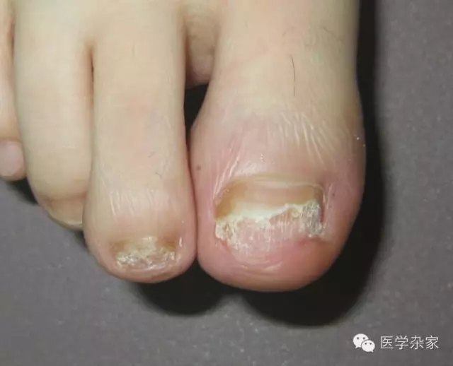 脚气为啥不会断根,为什么脚气断不了根