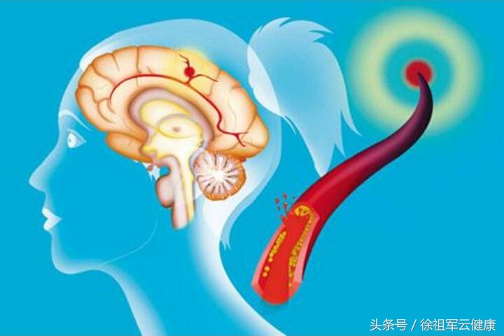 从2例脑血管疾病后遗症的康复,谈其综合理疗调理方案的实施
