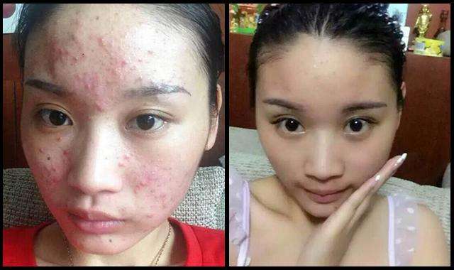 悄然流行的祛痘神器：珂玥（coco）老师的“3×1定期跟踪疗法”