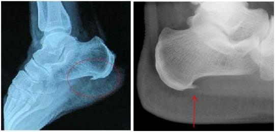 脚后跟疼长了骨刺怎么办,脚后跟痛还有骨刺怎么办啊