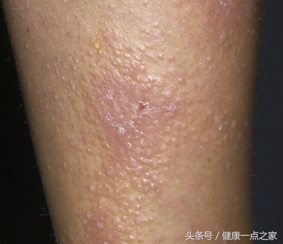 湿疹出现的原因和治疗方法,湿疹的症状和鉴别方法