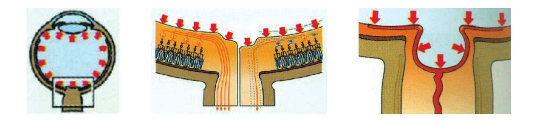 青光眼的知识扩展,青光眼疾病知识