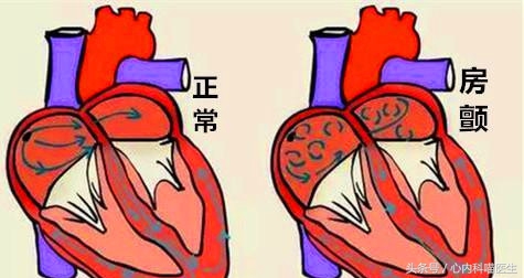 房颤患者服用胺碘酮的作用与效果,房颤胺碘酮用法指南