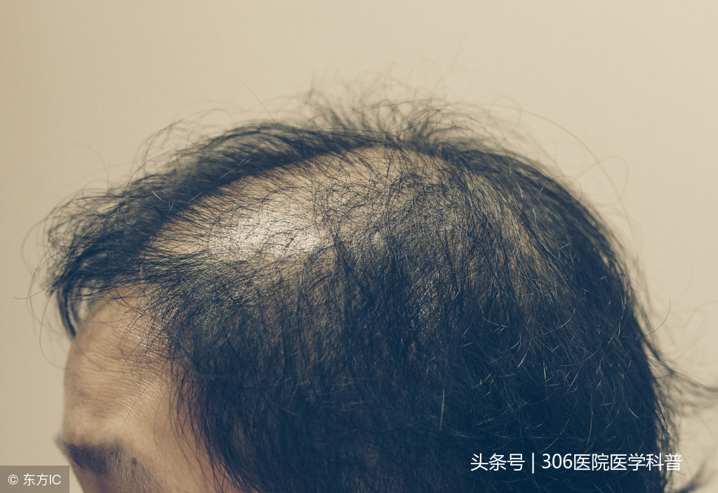 脂溢性脱发中医挂什么科,脂溢性脱发中医治疗方法