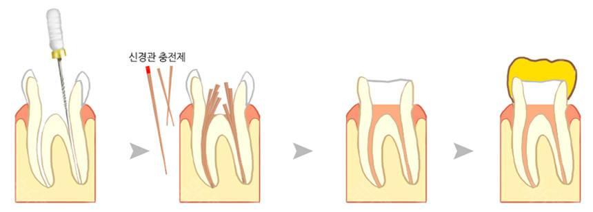 牙齿劈裂到什么程度就需要拔掉了,牙齿劈裂可以长好吗