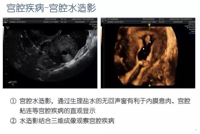 妇科超声波探头,福建省妇幼保健院输卵管超声造影