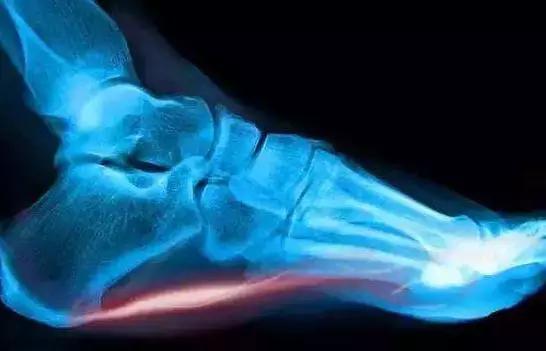 脚后跟疼是肾有问题么,专治脚后跟疼的骨刺特效药