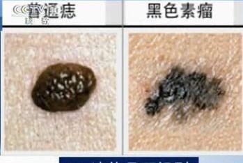 点痦子祛痣要格外注意安全,点痦子点坏了