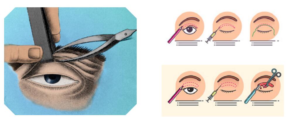 三角眼双眼皮手术前后对比,眼整形和双眼皮的区别