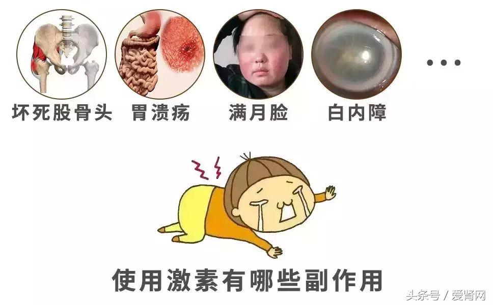 激素副作用太多？让医生教你几招